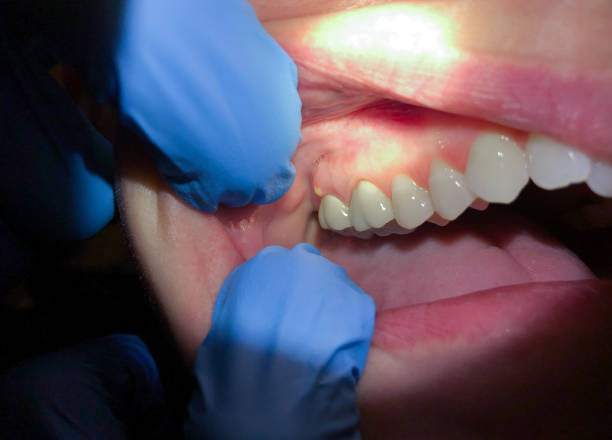 Best Emergency Dental Care for Broken or Chipped Teeth in Red Hill, PA
